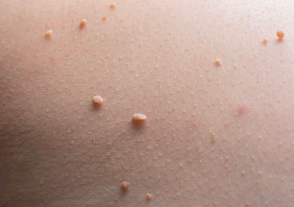 Close-up of skin with multiple small, raised flesh-colored skin growths.