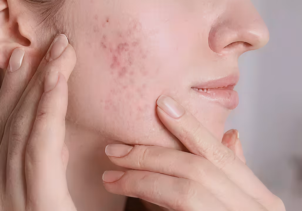 Close-up of a woman's cheek with acne and redness, with her fingers touching the skin.