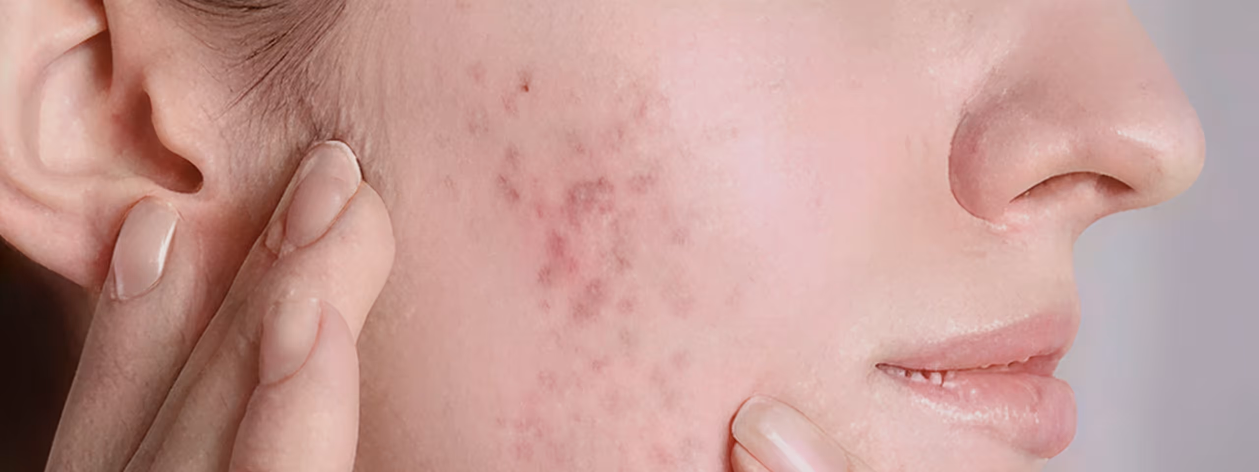 Close-up of a person's cheek showing red acne scars and blemishes with fingers touching the face.
