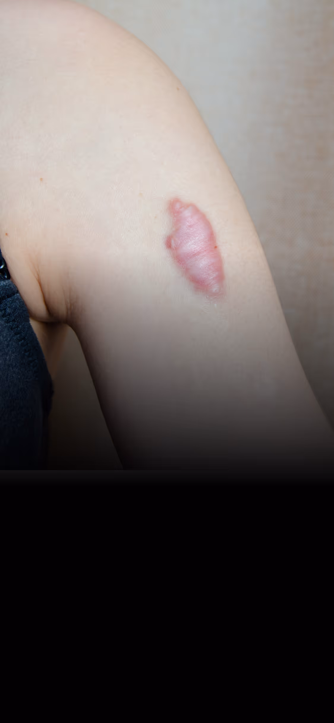 Raised, red keloid scar on the upper arm of a person with light skin.