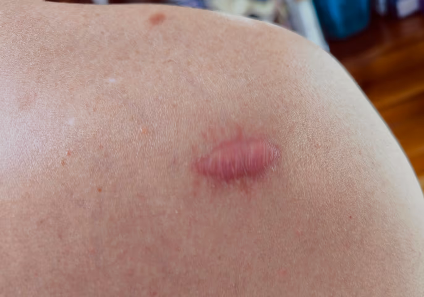 Close-up of skin with a raised, red, oval-shaped scar or wound on the shoulder area.