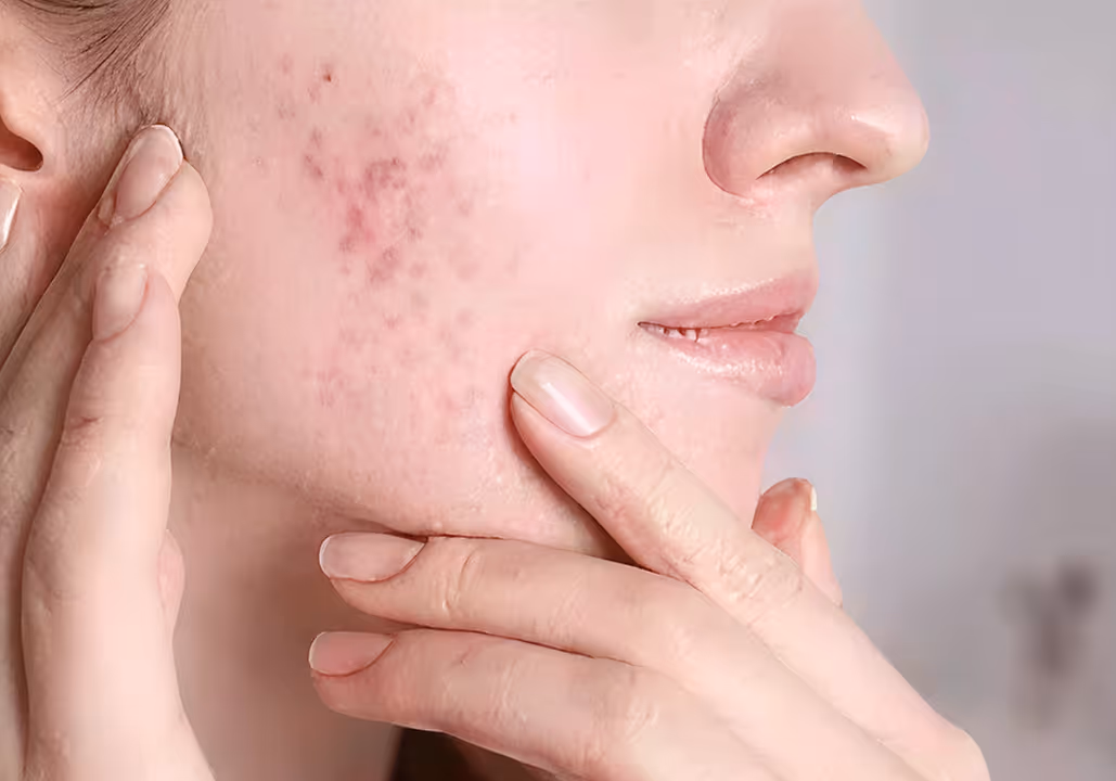 Close-up of a person with acne and redness on their cheek, touching their face with both hands.