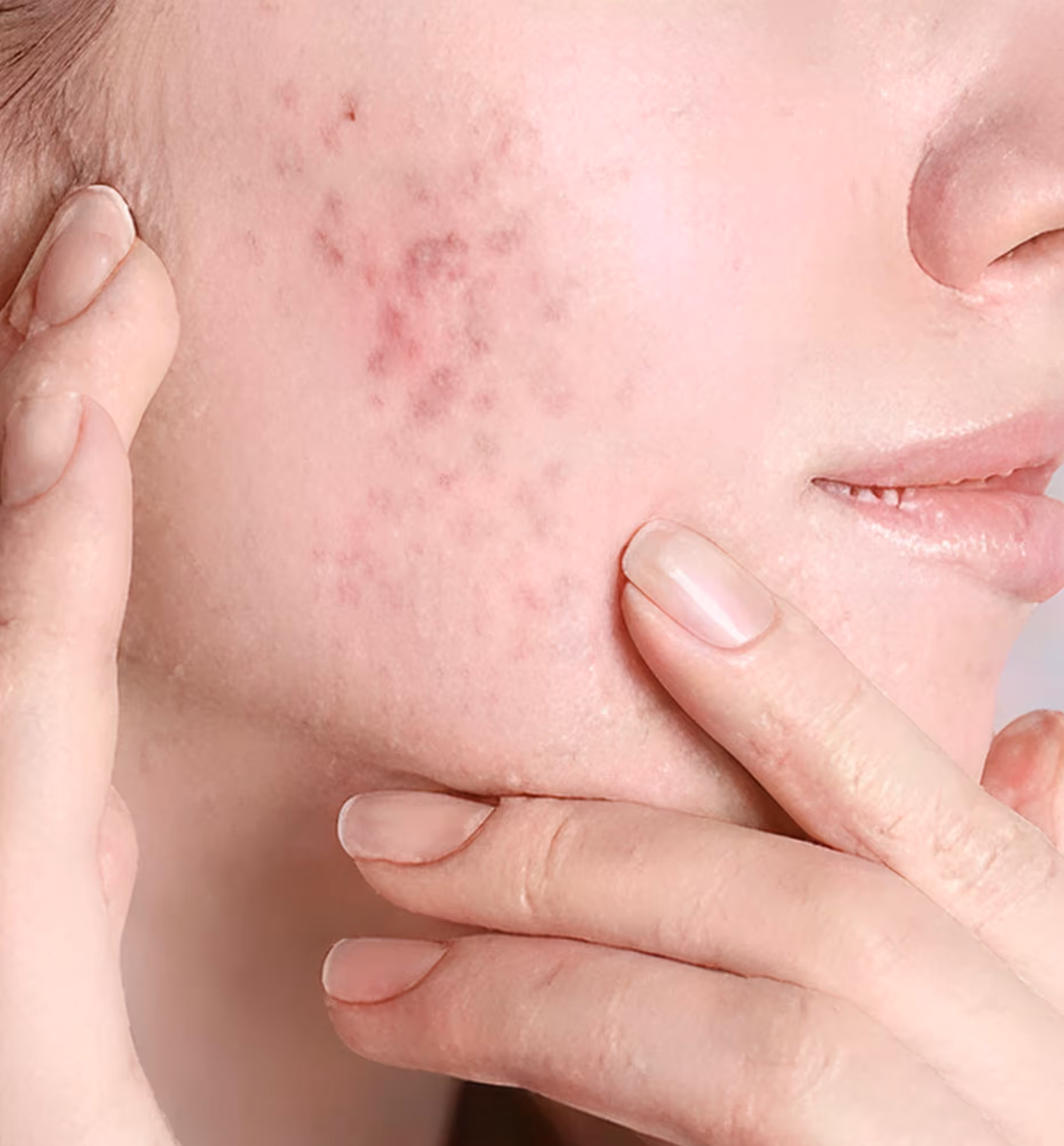 Close-up of a person's cheek with acne scars and fingers touching the skin.