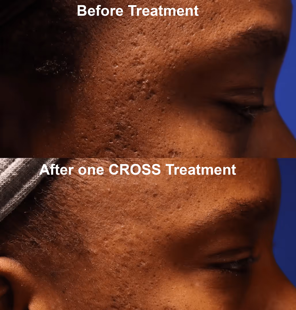 Side-by-side close-ups showing acne scars before and after one CROSS treatment on a man's cheek.