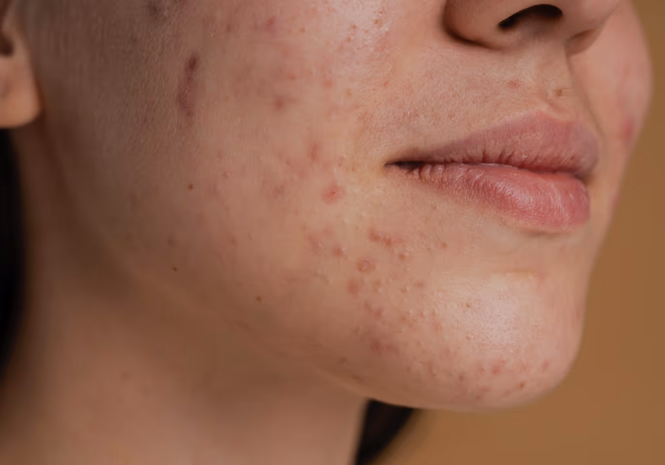 Close-up of a person's face showing acne and blemishes on the cheek and chin.