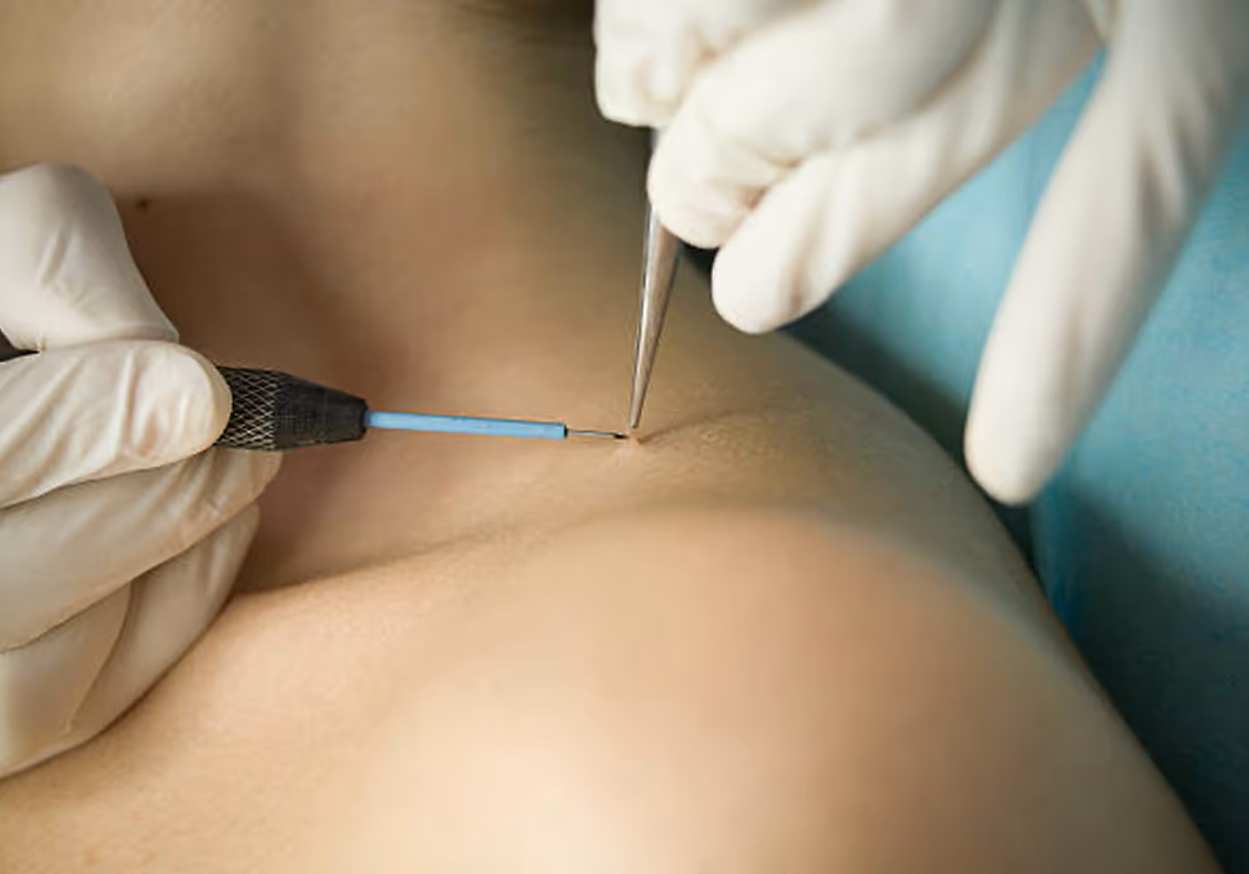 Close-up of gloved hands using a small tool to perform skin treatment near collarbone.