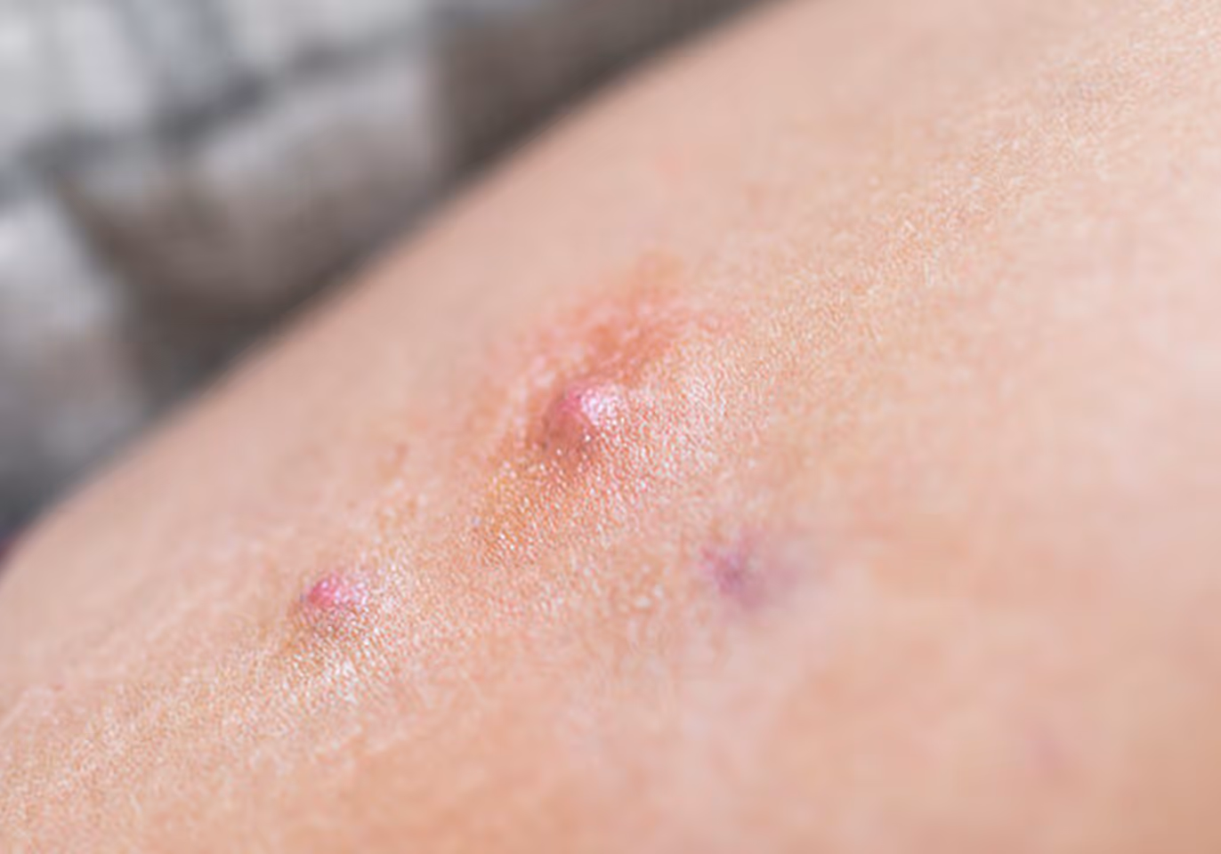 Close-up of skin with three red inflamed pimples, possibly acne or insect bites.