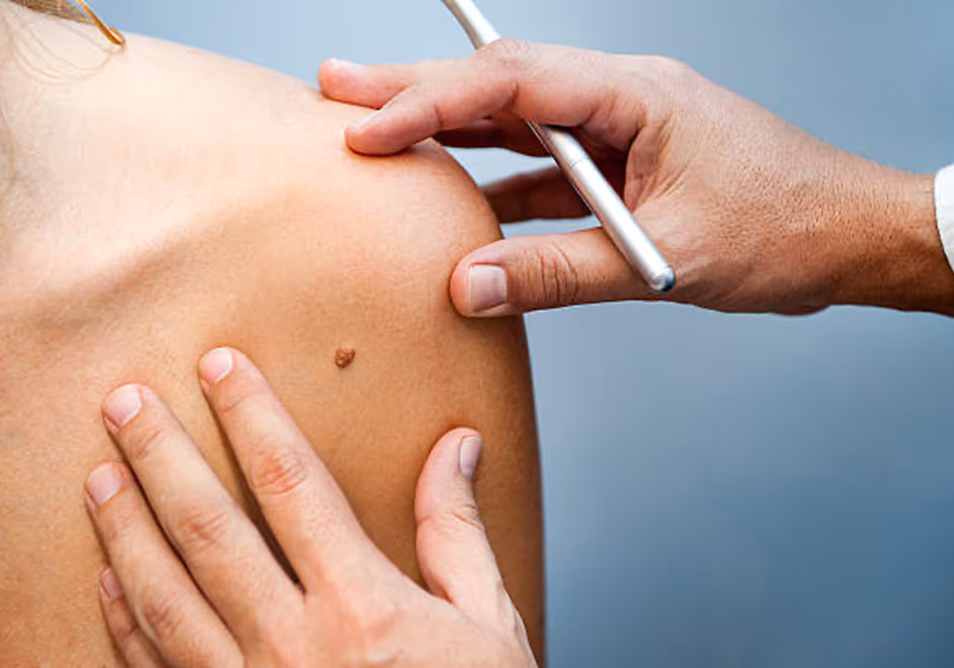 Doctor examining a brown mole on a patient's shoulder using a penlight.