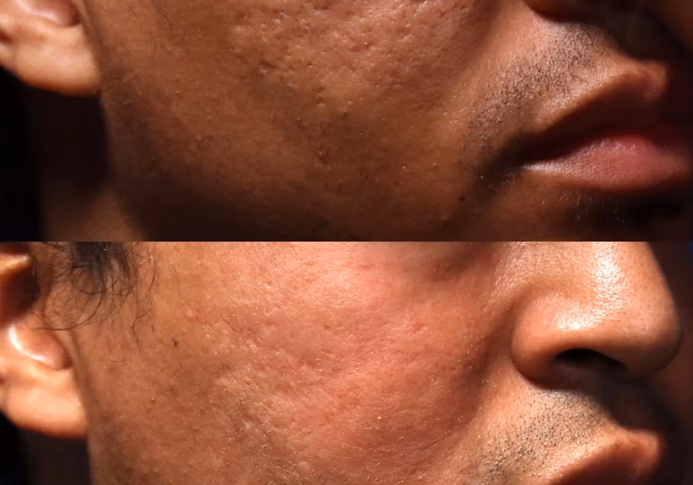 Close-up comparison of a man's cheek before and after acne scar treatment showing skin improvement.