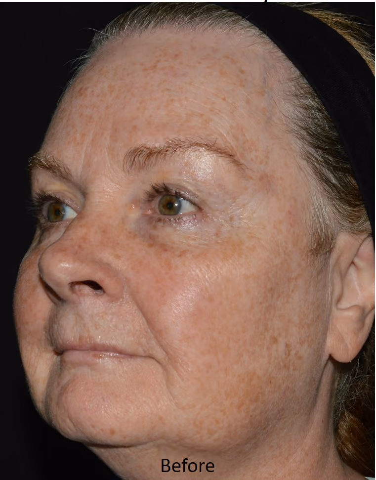 The same cheek and eye area before treatment, with sun spots and uneven texture.