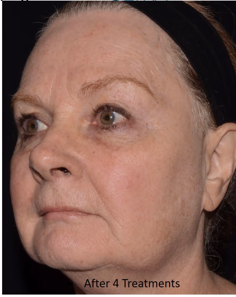 Cheek and eye area after four LaseMD Ultra treatments, with clearer tone and smoother texture.