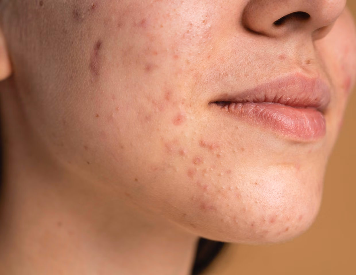 Close-up of a person's lower face showing acne and red blemishes on cheek and chin skin.