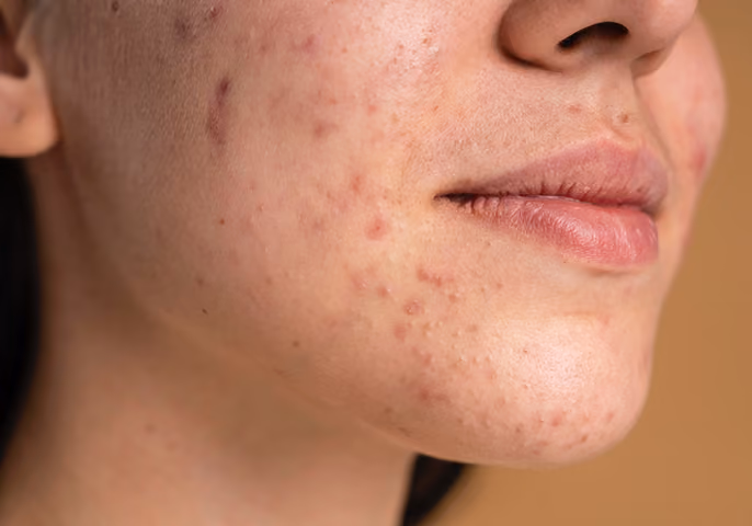 Close-up of a person's lower face showing mild to moderate acne with red spots and pimples on the cheek and chin.