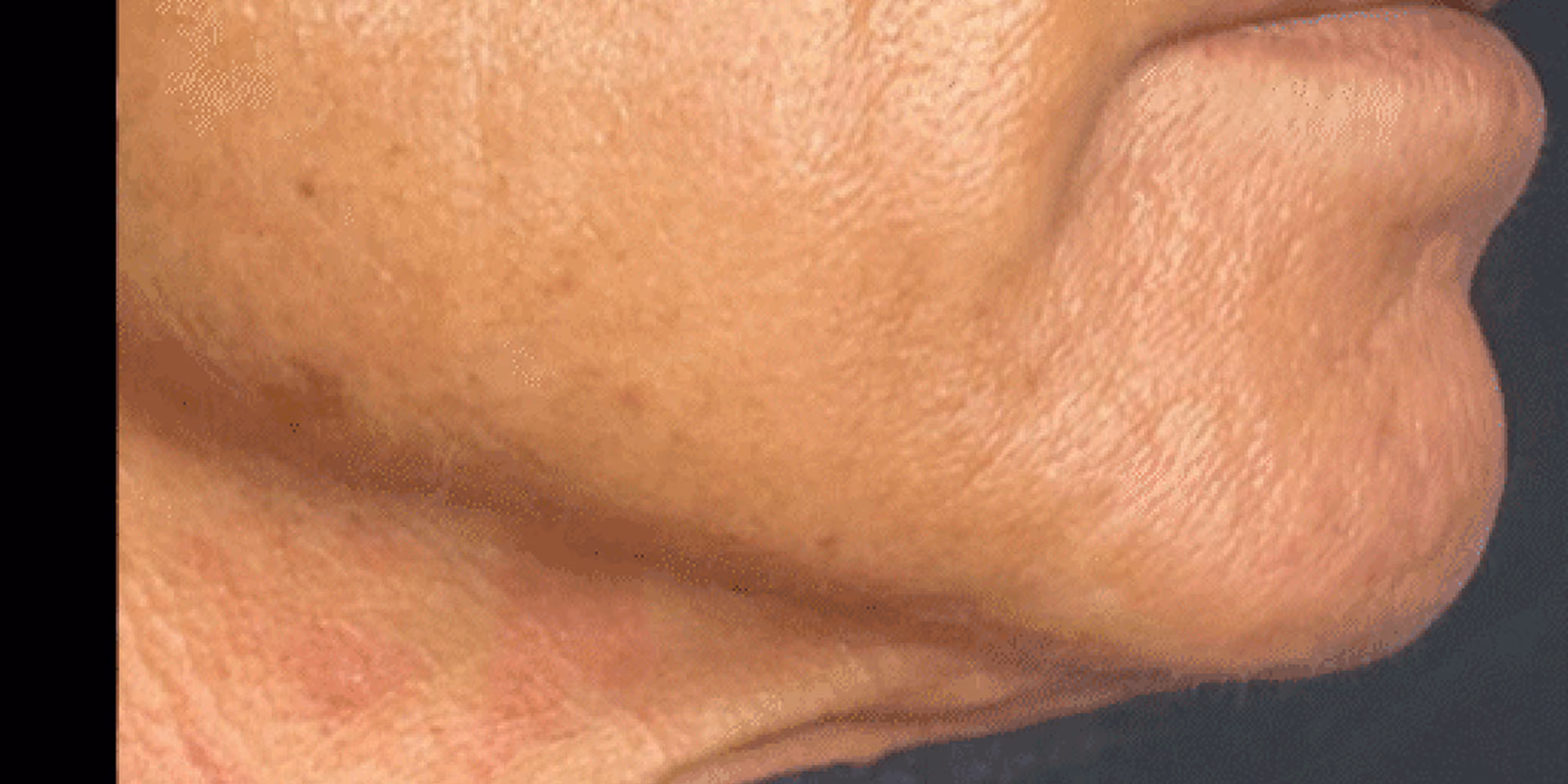 Close-up view of a person's lower face and neck showing textured, aged skin with fine lines and some redness.