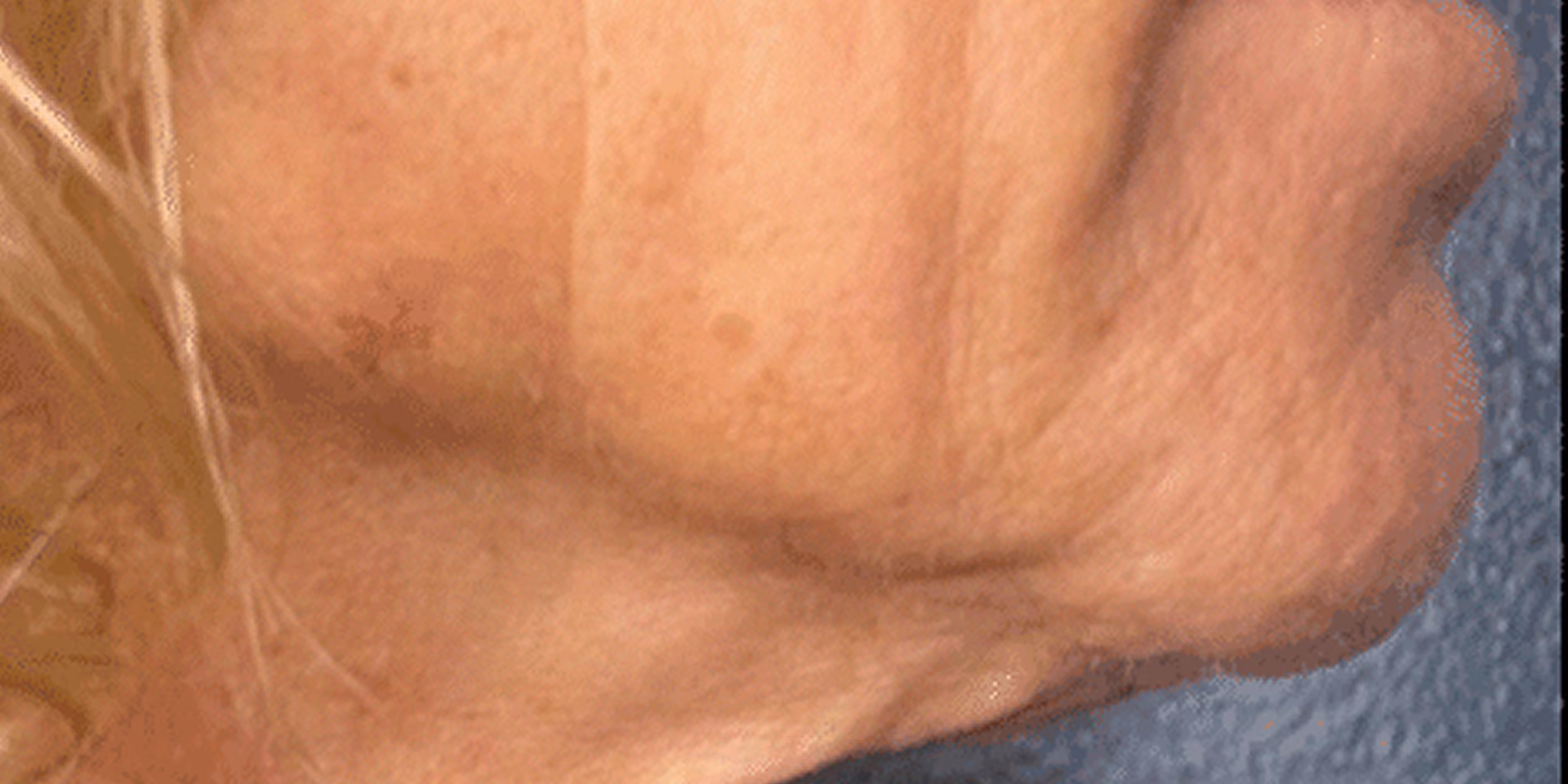 Close-up side view of an older person's lower face and neck showing wrinkles and sagging skin.