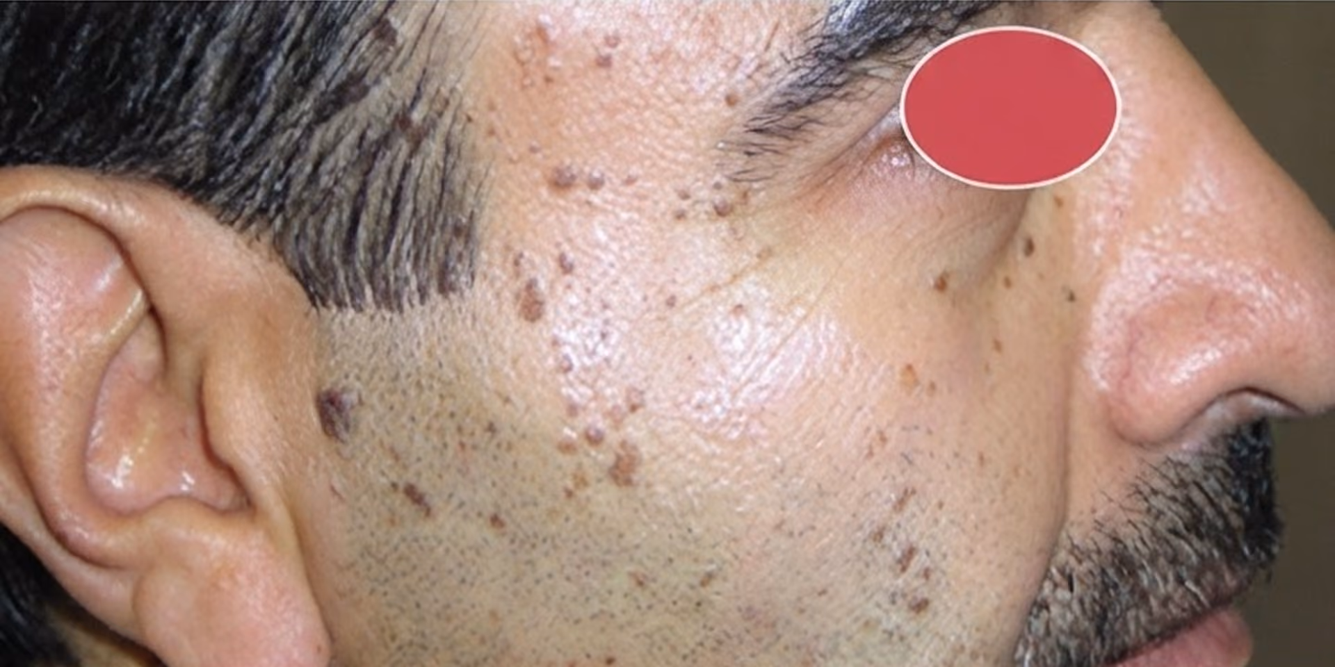 Close-up of a man's face showing multiple dark spots and blemishes on his cheek and temple area near the nose and ear.