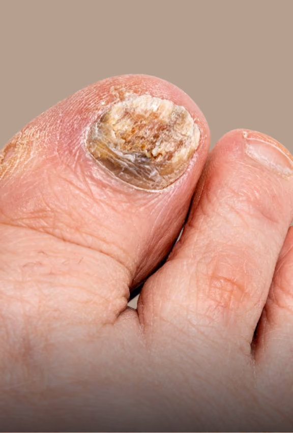 Close-up of a big toe with a thick, discolored, and damaged toenail, indicating possible fungal infection or nail disorder.