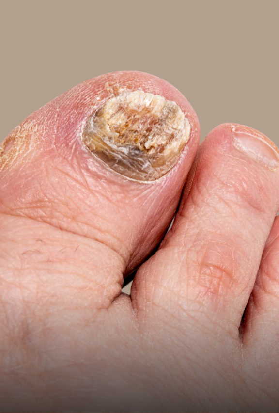 Close-up of a big toe with a thick, discolored, and damaged toenail, indicating possible fungal infection or nail disorder.