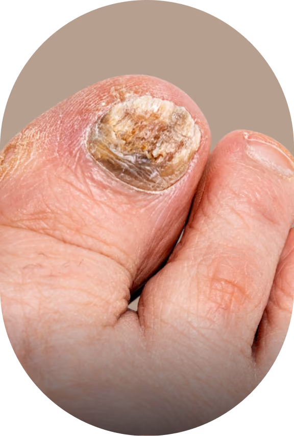 Close-up of a big toe with a thick, discolored, and damaged toenail, indicating possible fungal infection or nail disorder.