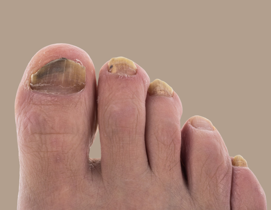 Close-up of four toes with thick, discolored, and damaged toenails, indicating possible fungal nail infection or damage.