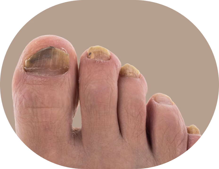 Close-up of four toes with thick, discolored, and damaged toenails, indicating possible fungal nail infection or damage.