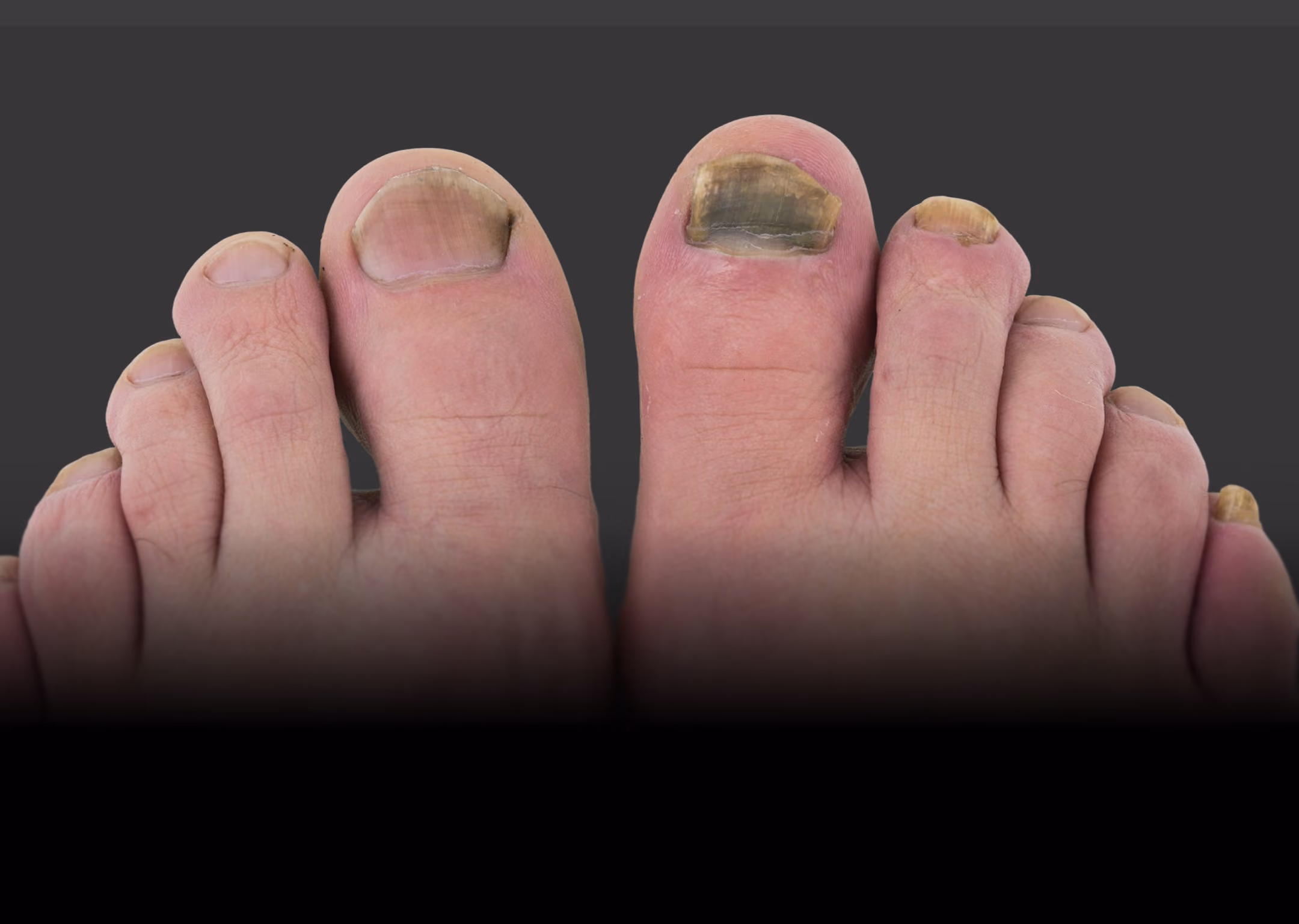 Close-up of feet with thick, discolored, and damaged toenails, indicating possible fungal infection or nail injury, against a dark gray background.