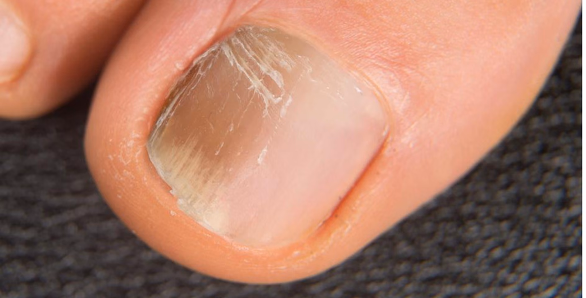 Close-up of a toenail with discoloration and white patches against a dark textured background.