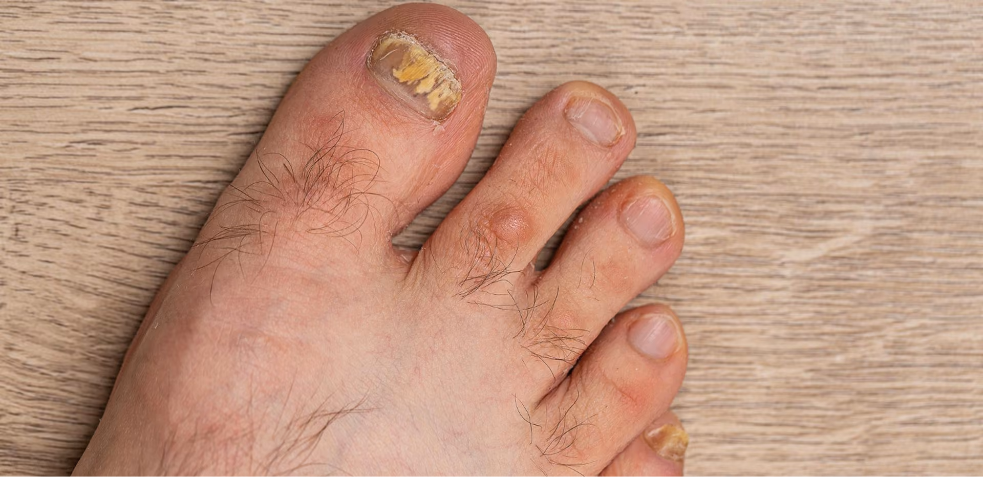 Close-up of a foot with thickened, yellow, brittle toenails, indicating possible fungal nail infection.