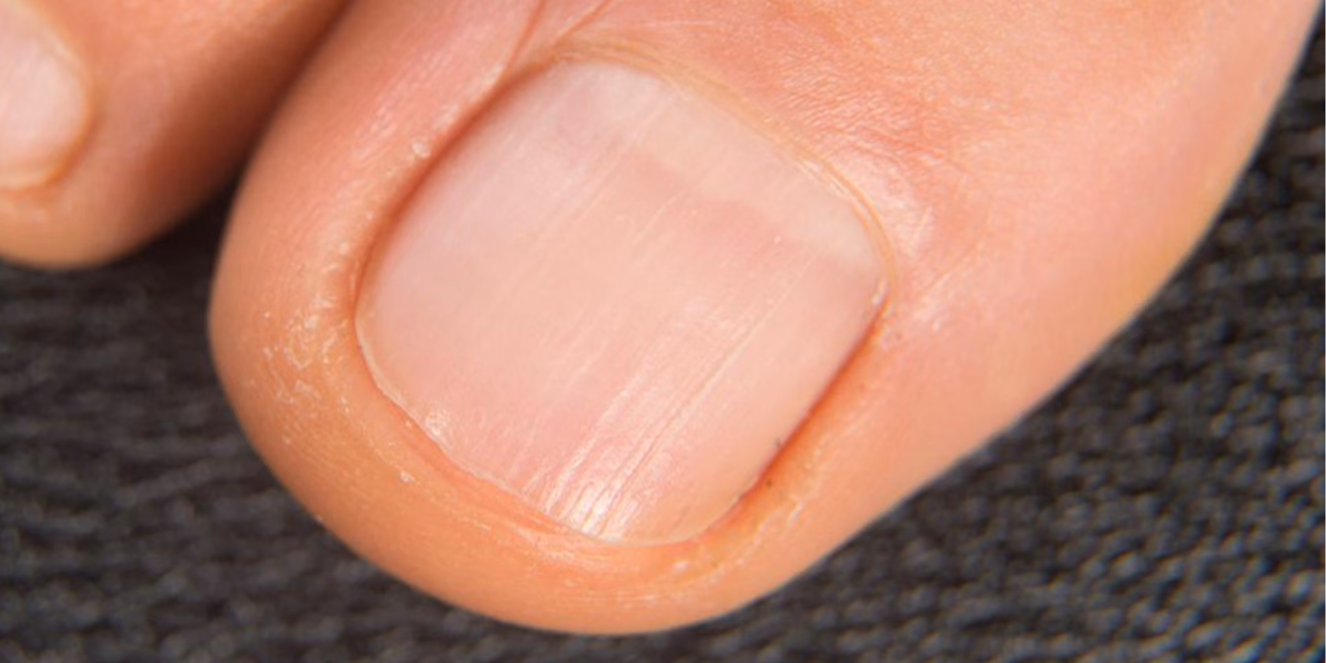 Close-up of a person's thumbnail with natural, trimmed nail and slightly dry skin around the cuticle on a textured dark background.
