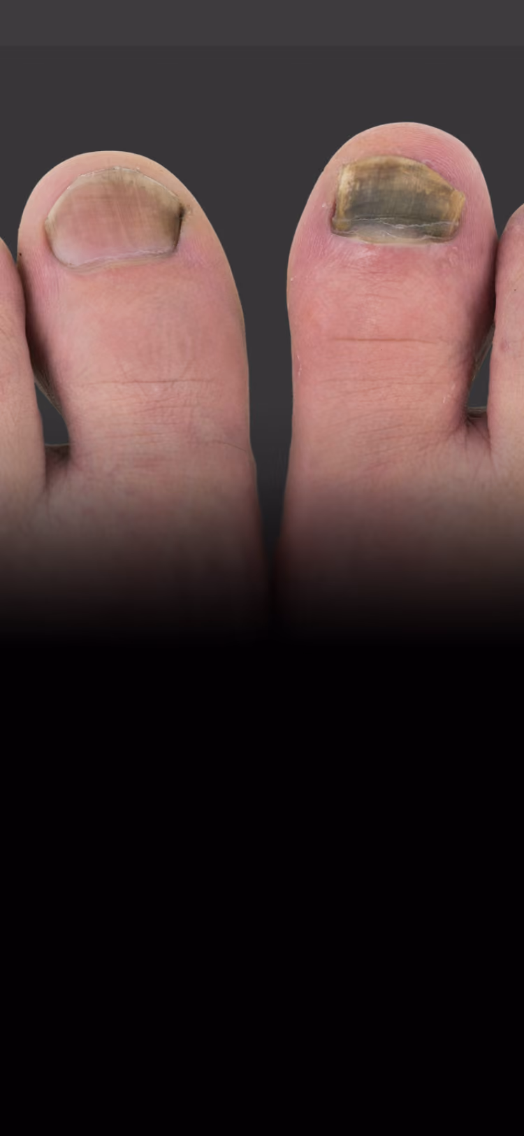 Close-up of two big toes with damaged, darkened toenails, indicating possible fungal infection or trauma.