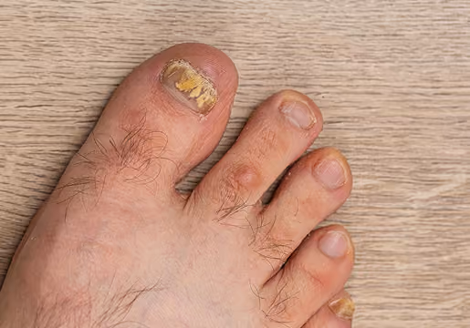 Close-up of a foot with thick, yellowed, and damaged toenails on the big toe and little toe, showing signs of possible fungal infection on a wood-textured background.
