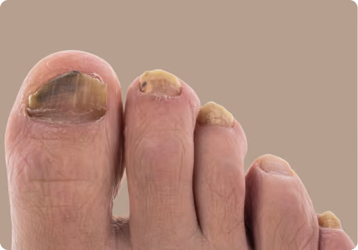 Close-up of toes with thick, yellowed, and damaged toenails, possibly indicating a fungal nail infection.