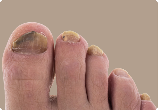 Close-up of toes with thick, yellowed, and damaged toenails, possibly indicating a fungal nail infection.