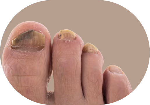 Close-up of toes with thick, yellowed, and damaged toenails, possibly indicating a fungal nail infection.