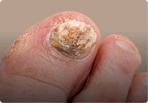 Close-up of a big toe with a discolored, thickened, and damaged toenail, showing signs of possible fungal infection or nail disorder.