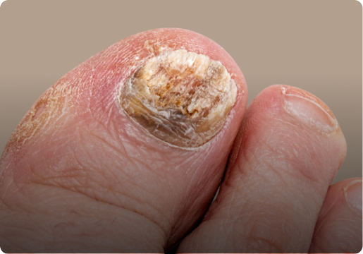 Close-up of a big toe with a discolored, thickened, and damaged toenail, showing signs of possible fungal infection or nail disorder.