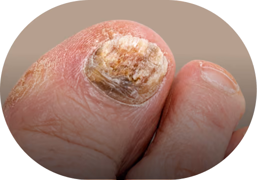 Close-up of a big toe with a discolored, thickened, and damaged toenail, showing signs of possible fungal infection or nail disorder.