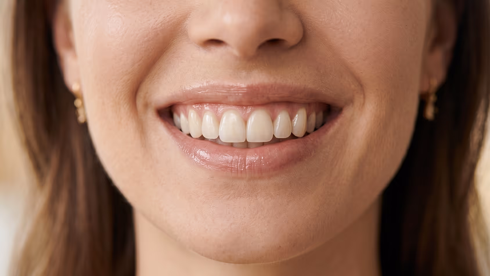 догляд за вінірами та термін служби — стоматологія Allure Dental