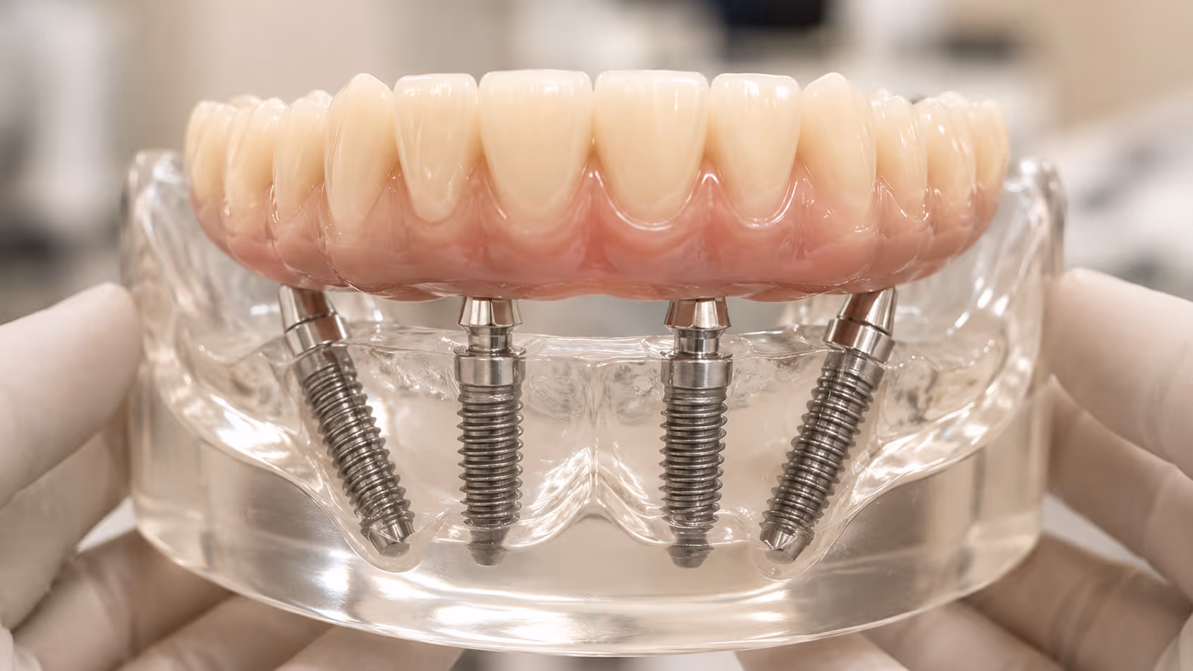 протезування All-on-4 при повній відсутності зубів — Allure Dental Київ