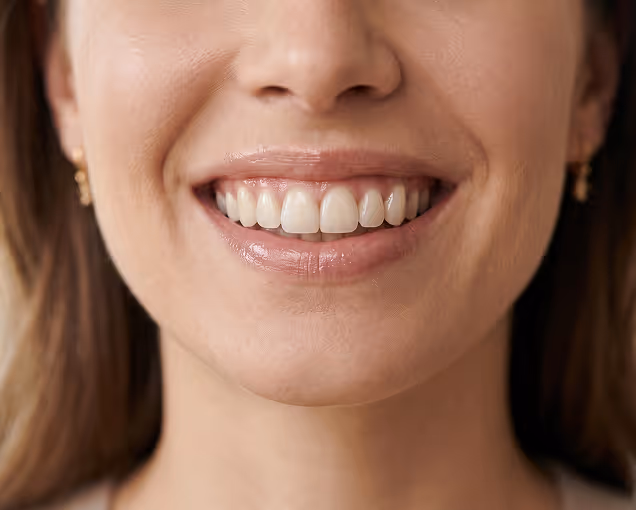 догляд за вінірами та термін служби — стоматологія Allure Dental