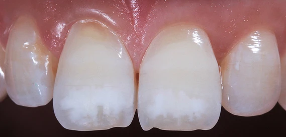 Icon White Spot Removal treatment at Clarendon Dental Spa in Leeds