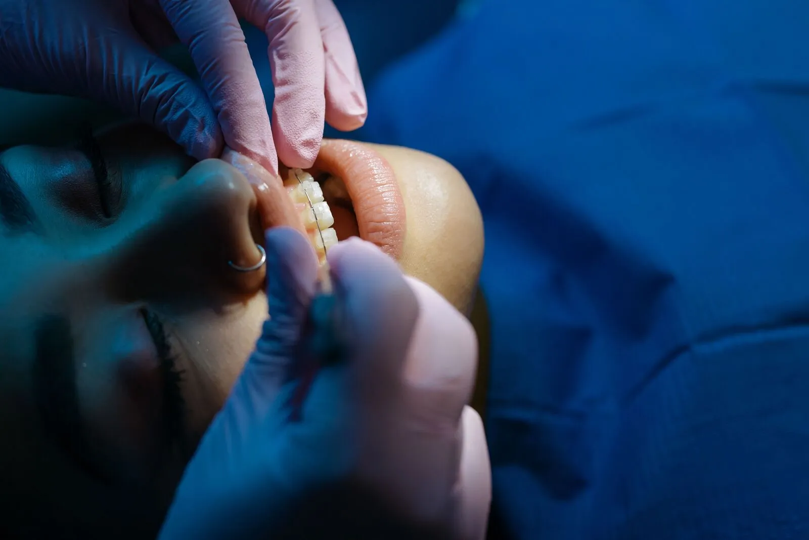 Brace removal and debonding at Clarendon Dental Spa in Leeds