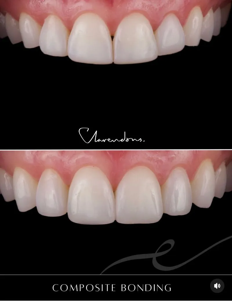 Composite bonding reshaping a chipped front tooth at Clarendon Dental Spa in Leeds