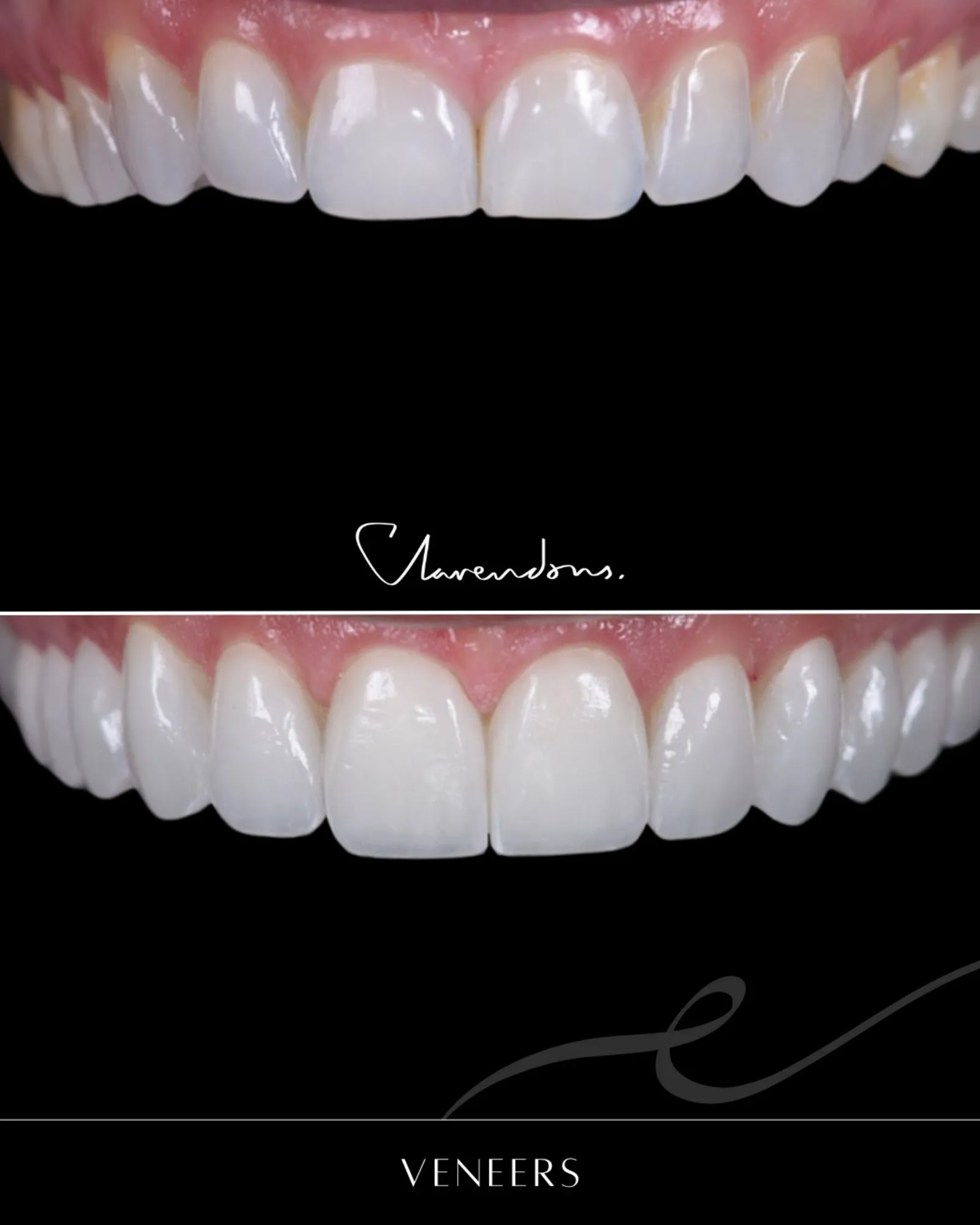 Dental veneers to restore a chipped front tooth at Clarendon Dental Spa in Leeds