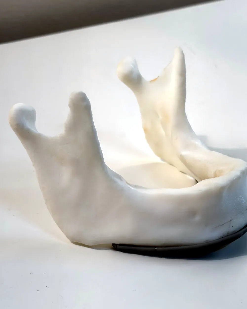 Modelo impreso en 3D de la mandíbula de una paciente, para planificar la cirugía