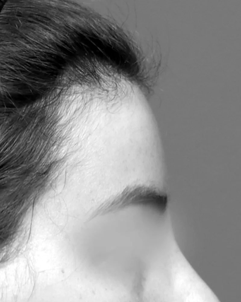 Perfil de otra paciente tras la feminización de frente, en blanco y negro