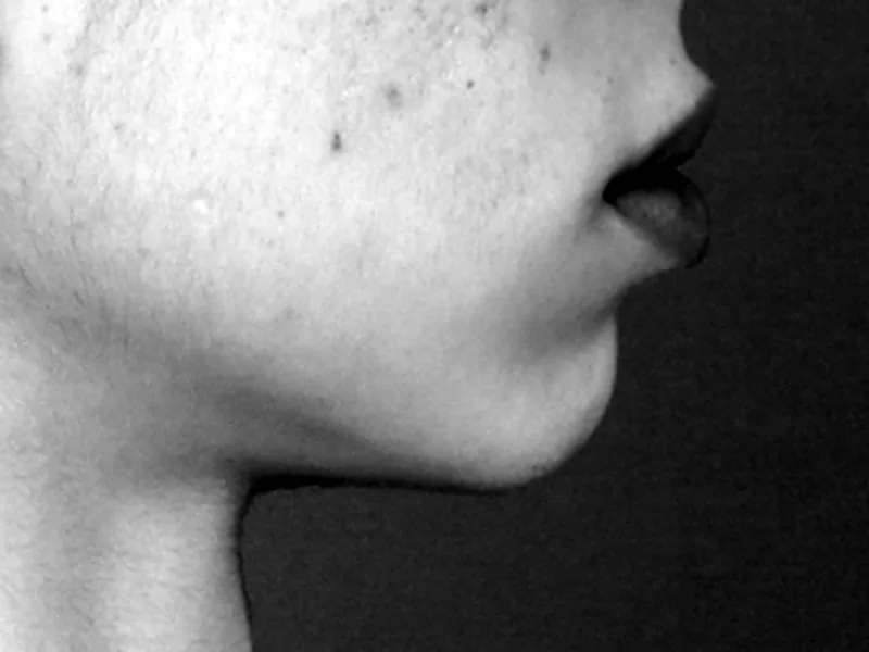 Mandíbula y mentón de perfil, antes de la reducción