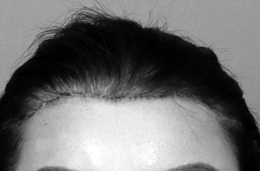 Incisión por la línea del pelo una semana después de la feminización de frente, todavía con los puntos, en blanco y negro