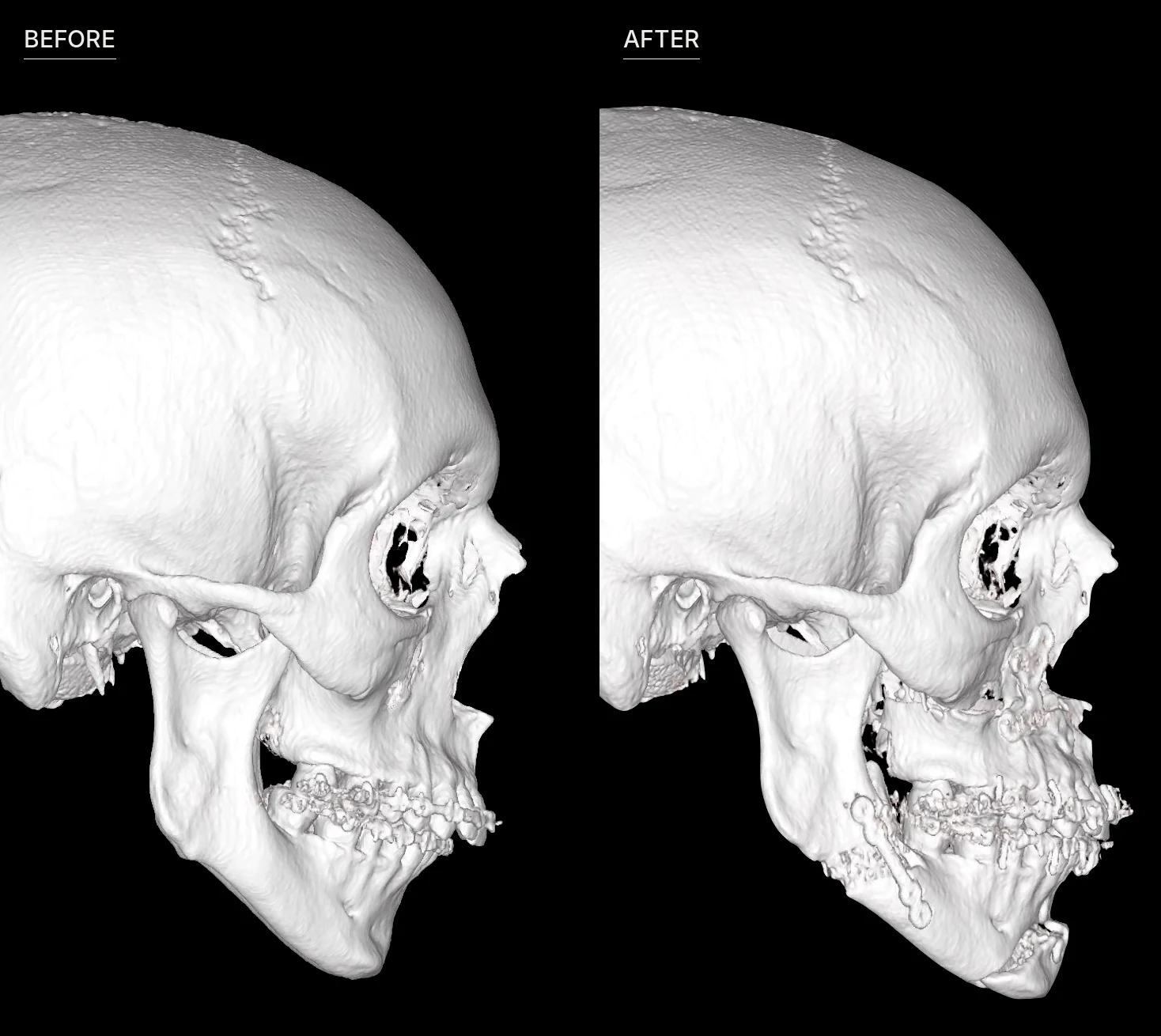 Side-by-side 3D CT side views of the same patient before and after a chin osteotomy combined with jaw surgery