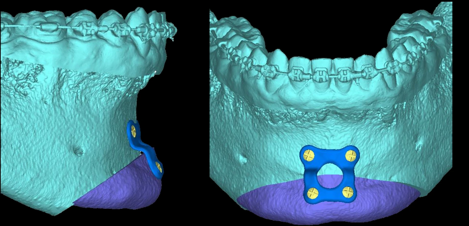 3D plan of the lower jaw with the advanced chin segment in purple fixed by a custom plate, side and front views